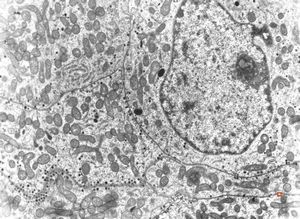 M, 47y. | chromophobic pituitary adenoma (ACTH) M, 47y. | chromophobic pituitary adenoma (ACTH)
